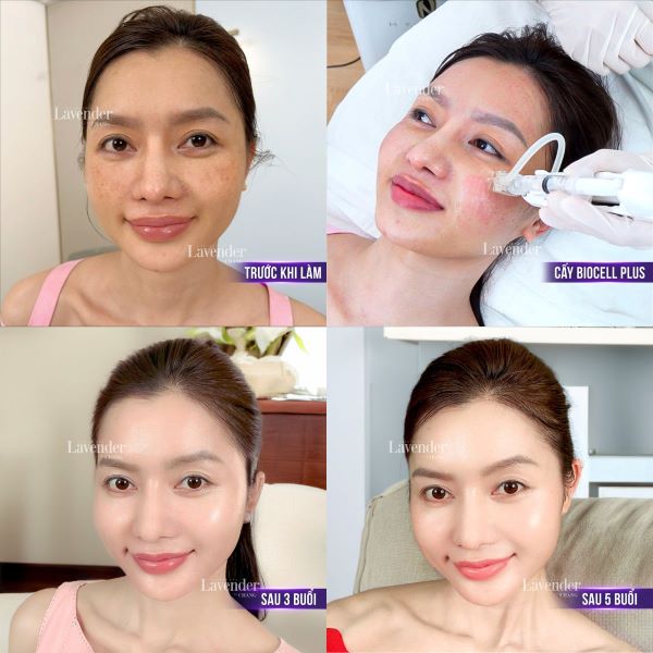 Làn da khách hàng thay đổi sau khi tiêm Biocell Plus