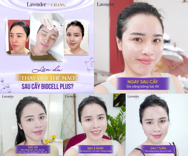 Sự thay đổi rõ rệt của làn da sau khi cấy Biocell Plus