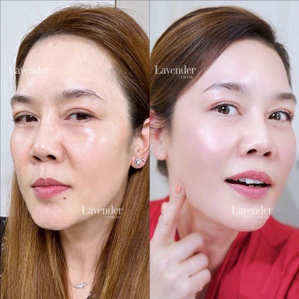 Ca sĩ Thu Phương sau liệu trình Biocell Plus