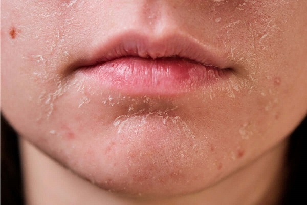 Da khô sạm, dễ có cảm giác ngứa cũng là một dấu hiệu lão hóa da sớm. Làn da mỏng, mất lớp dầu tự nhiên, thiếu ẩm nghiêm trọng, trở nên thô ráp, dễ kích ứng.