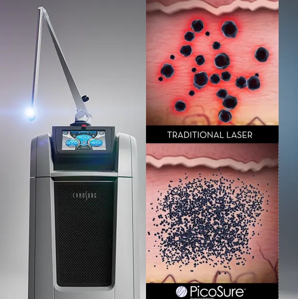 Laser Pico Pro sử dụng máy Laser Picosure - là Laser điều trị sắc tố da thế hệ mới nhất được FDA chứng nhận có thể phân rã và loại bỏ hoàn toàn gốc nám, tàn nhang & đồi mồi