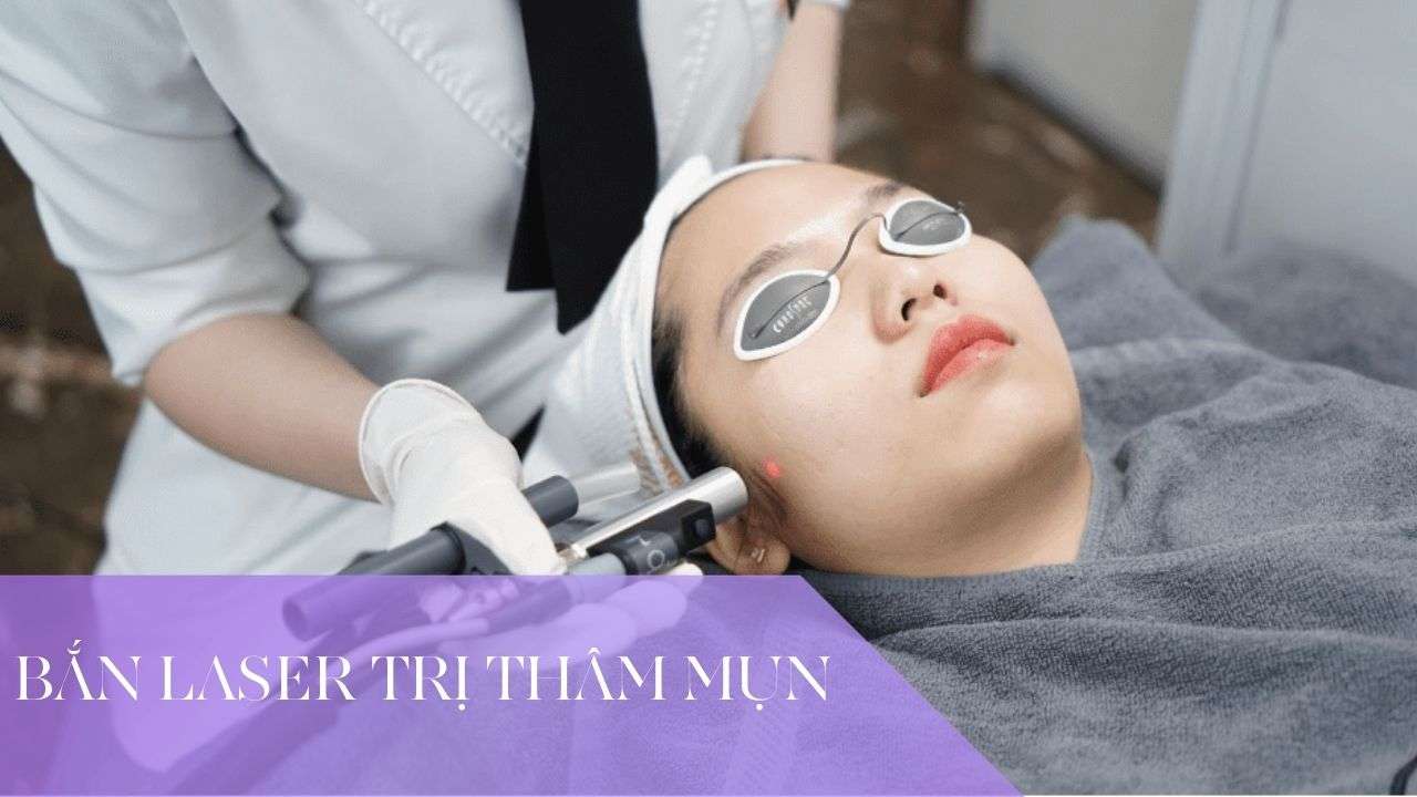 ban laser tri tham mun 11 - lavender by chang