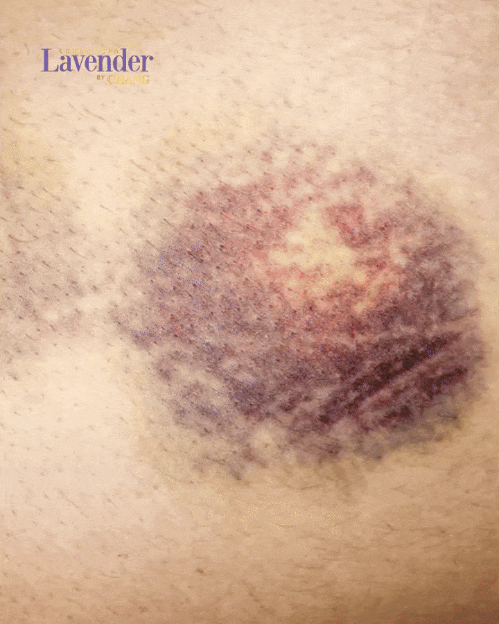 tiem filler co phai hydrat 2 1 - lavender by chang