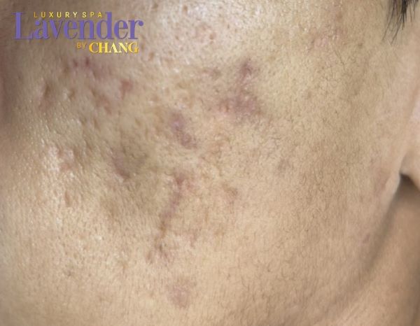 ban laser co de lai seo khong 3 - lavender by chang