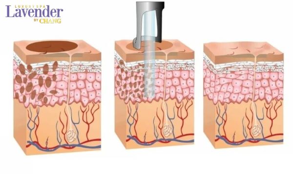 ban laser tan nhang co de lai seo khong 2 - lavender by chang