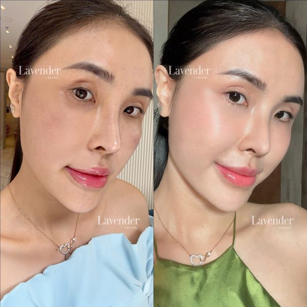 ban laser tan nhang co de lai seo khong 8 - lavender by chang