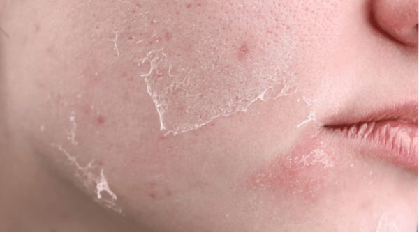 ban laser tri nam bao lau thi bong 2 - lavender by chang