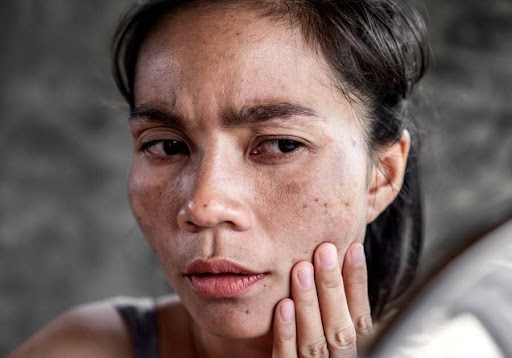 Nám có thể tái phát sau khi kết thúc liệu trình bắn laser