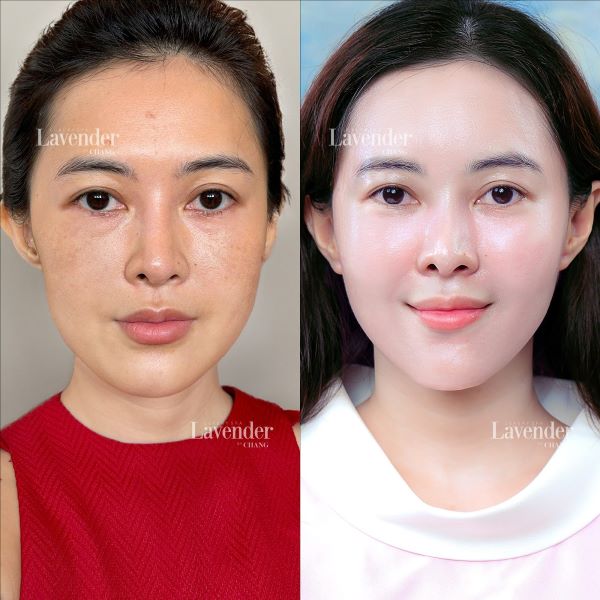 Bắn laser trị nám bao lâu thì hết?