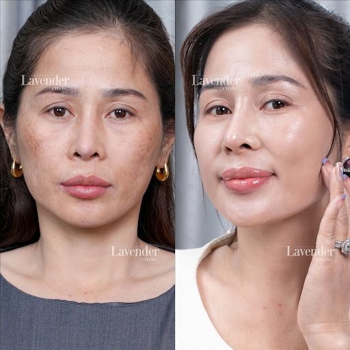 Bắn laser trị nám sau bao lâu thì hết