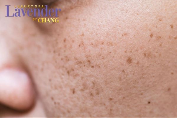 ban tia laser tri tan nhang bao nhieu tien 2 - lavender by chang