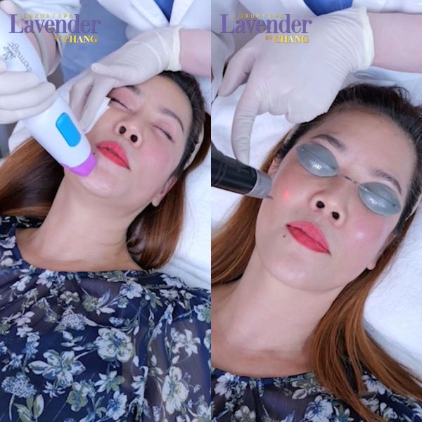 ban tia laser tri tan nhang bao nhieu tien 5 - lavender by chang