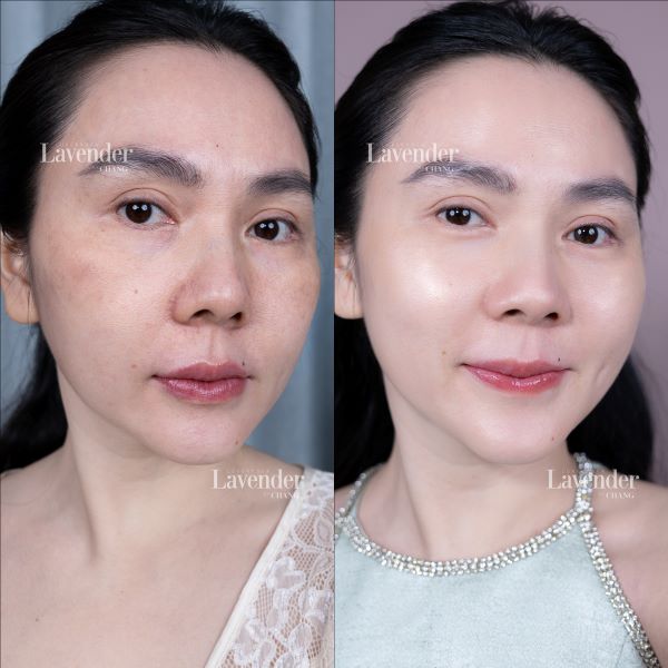 Khách hàng Lê Trang sạch nám 90% sau 6 buổi thực hiện liệu trình Biocell Complex