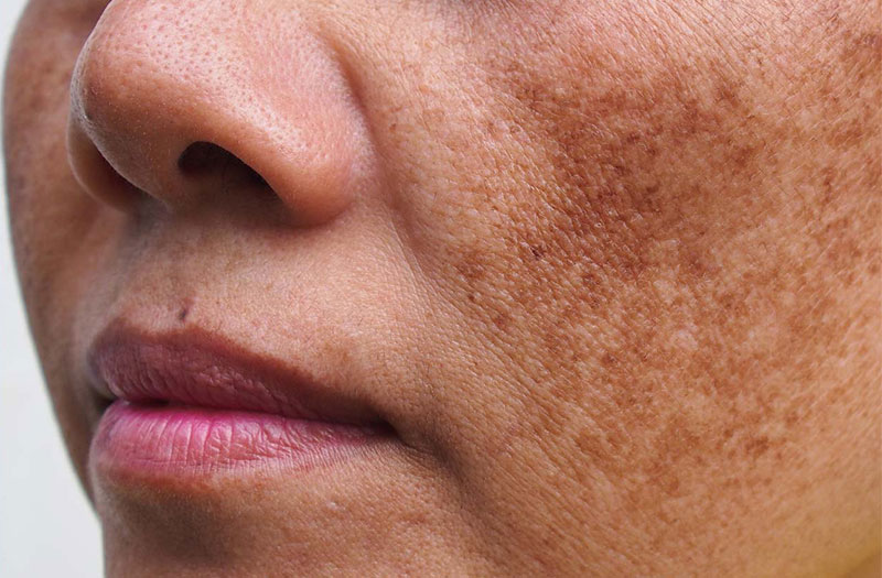 hình ảnh nám da ở mặt