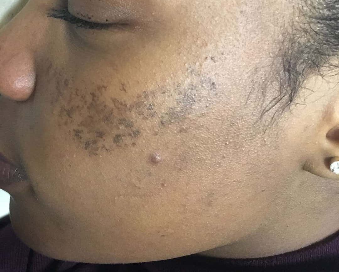 hình ảnh bị nám da ở má