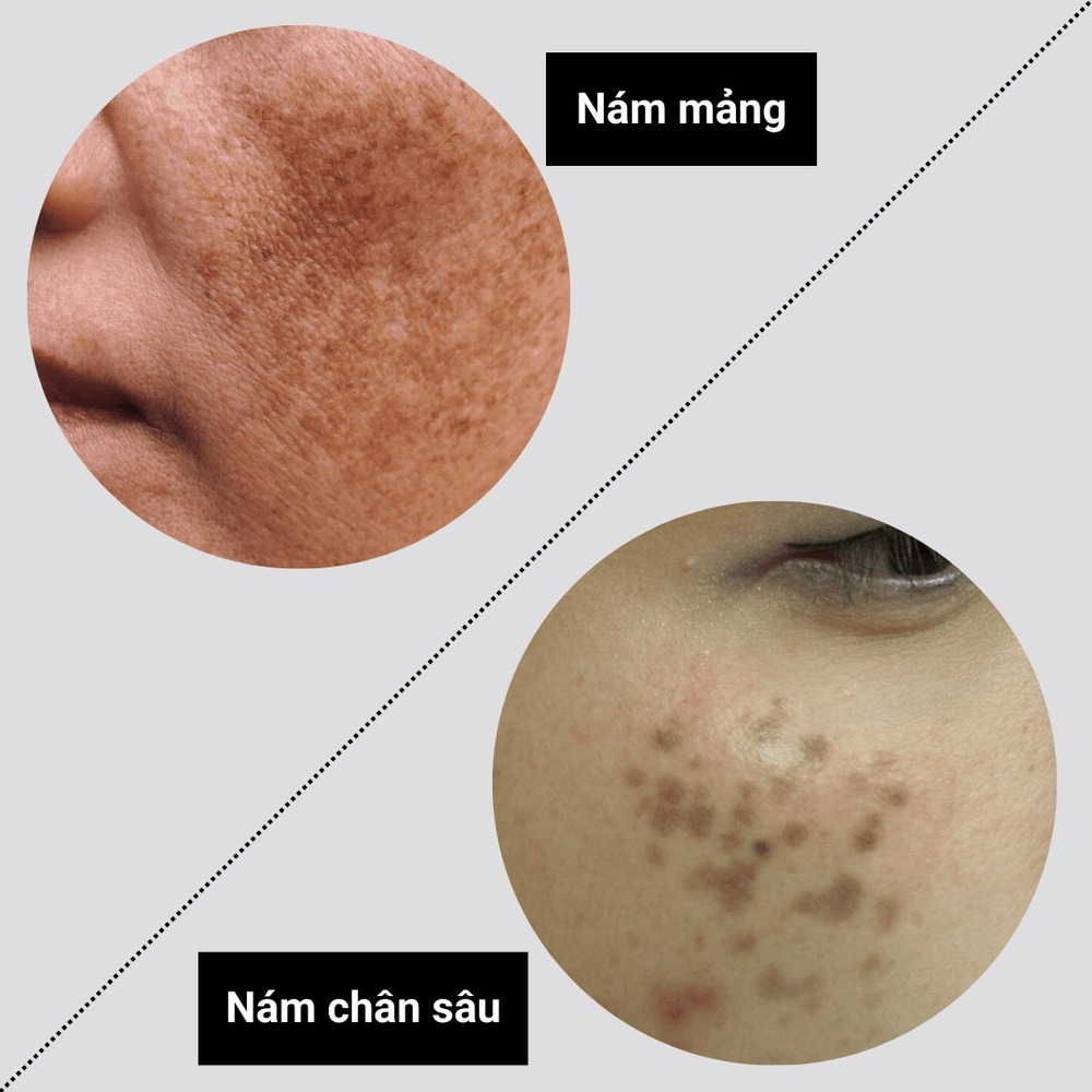 Nhận biết nám mảng và nám chân sâu để có cách điều trị hiệu quả | PPP