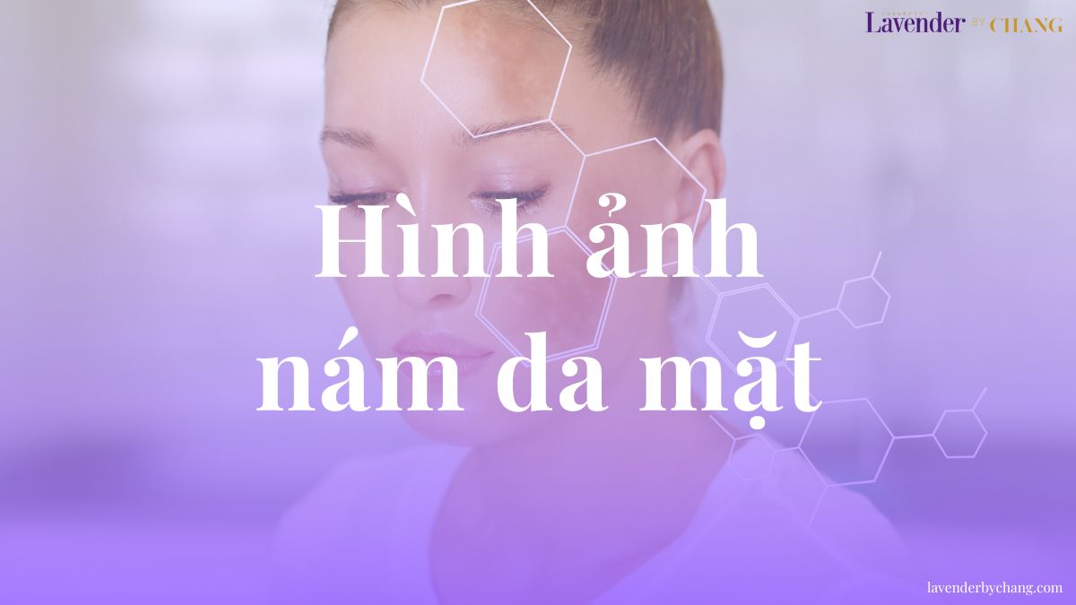 Hình ảnh nám da mặt