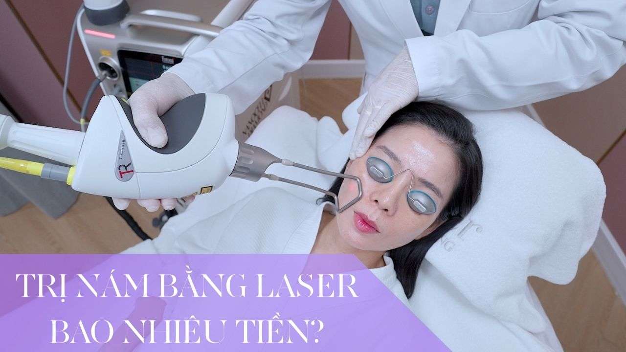 Trị nám bằng Laser bao nhiêu tiền? Giá từ 6 triệu/buổi