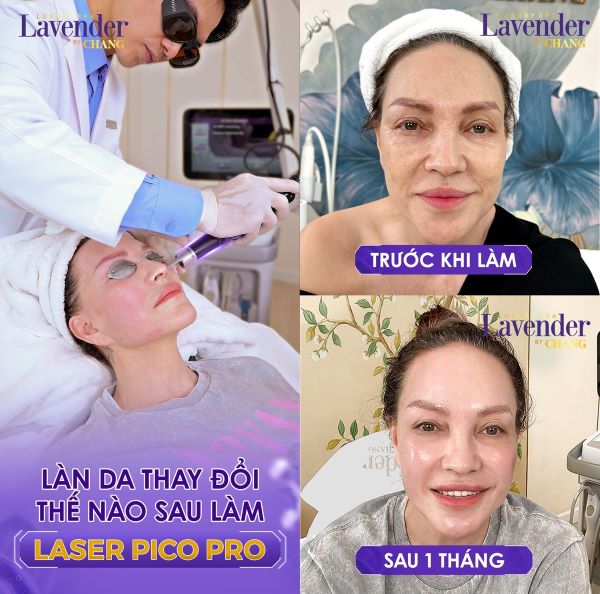 tri nam bang laser bao nhieu tien 5 - lavender by chang