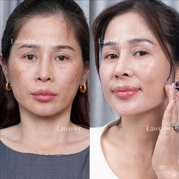 tri nam bang laser bao nhieu tien 6 - lavender by chang