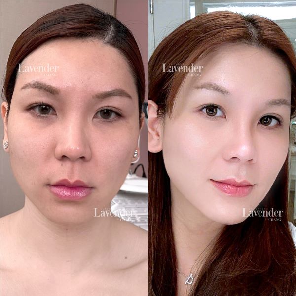 tri nam bang laser bao nhieu tien 9 - lavender by chang