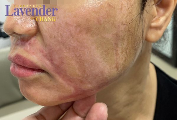 ban laser tri nam co dau khong 25458 6 e1763344543552 - lavender by chang