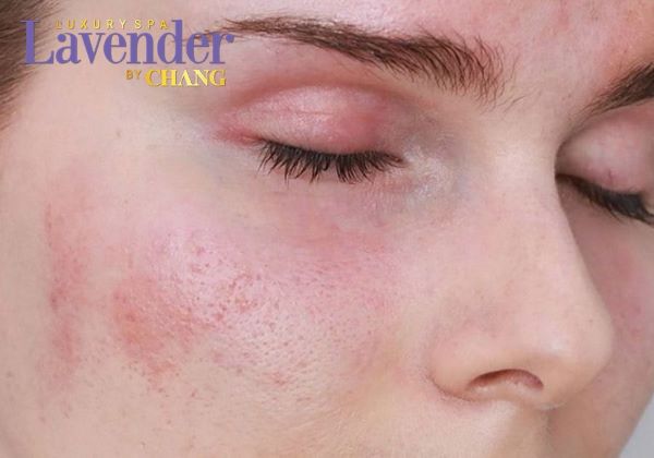 ban laser tri nam kieng an gi 1 - lavender by chang