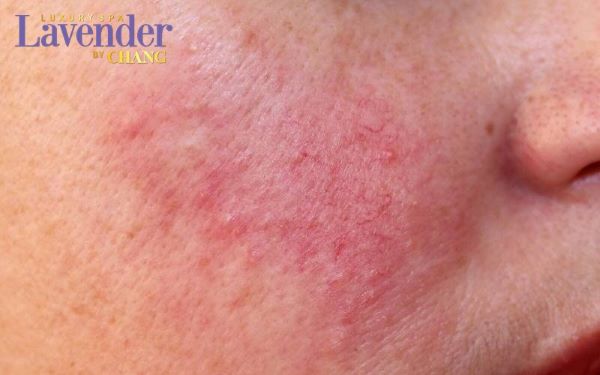 ban laser tri nam kieng an gi 12 - lavender by chang