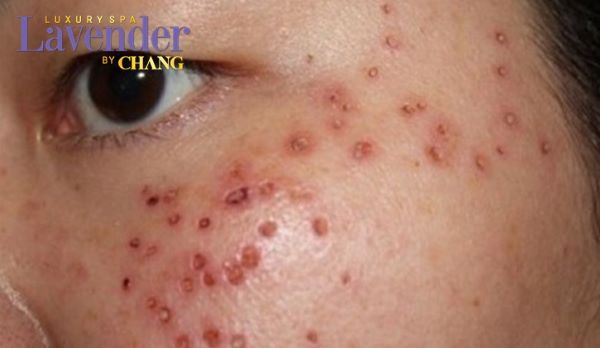 cach cham soc da sau khi ban laser tri nam 2 - lavender by chang