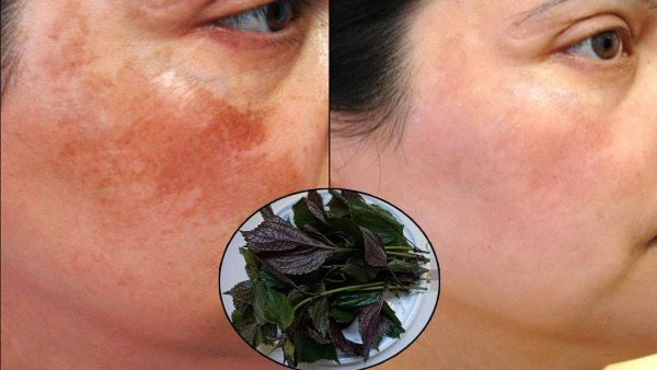 cach tri nam bang la tia to - lavender by chang