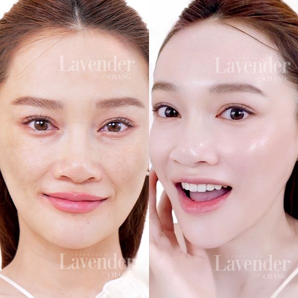 co bau co ban laser tri nam duoc khong 3 - lavender by chang