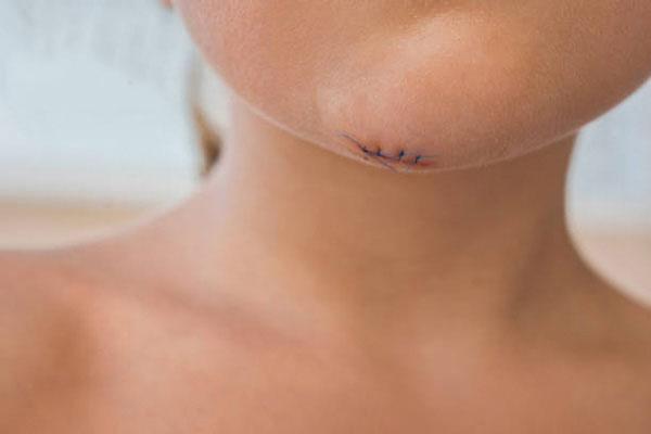 hut mo nong cam co de lai seo khong 25736 1 - lavender by chang