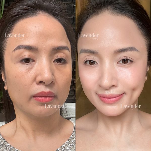 hut mo nong cam co gay me khong 25416 2 e1763172853555 - lavender by chang