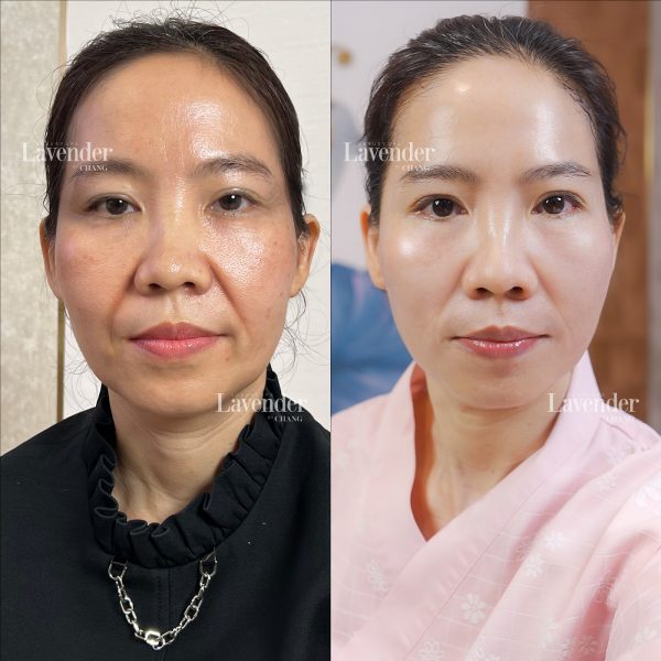 hut mo nong cam co gay me khong 25416 3 e1763172865729 - lavender by chang