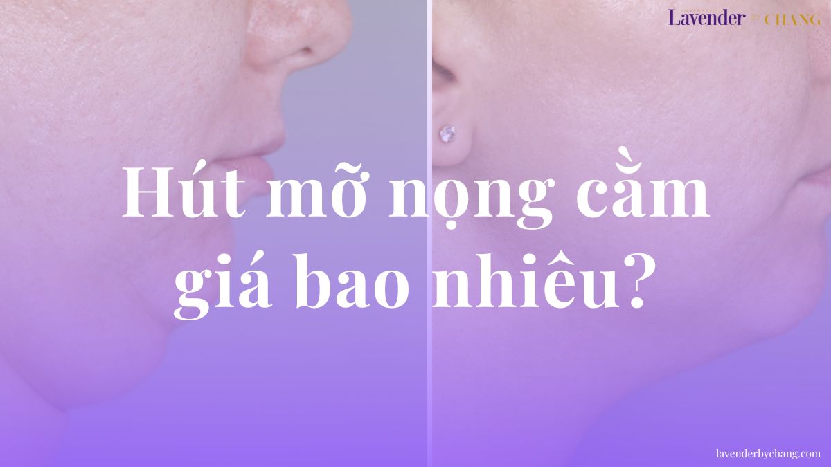 hút mỡ nọng cằm giá bao nhiêu