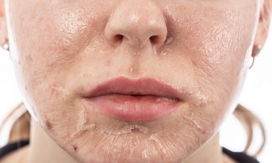 peel da laser tri nam 1 - lavender by chang