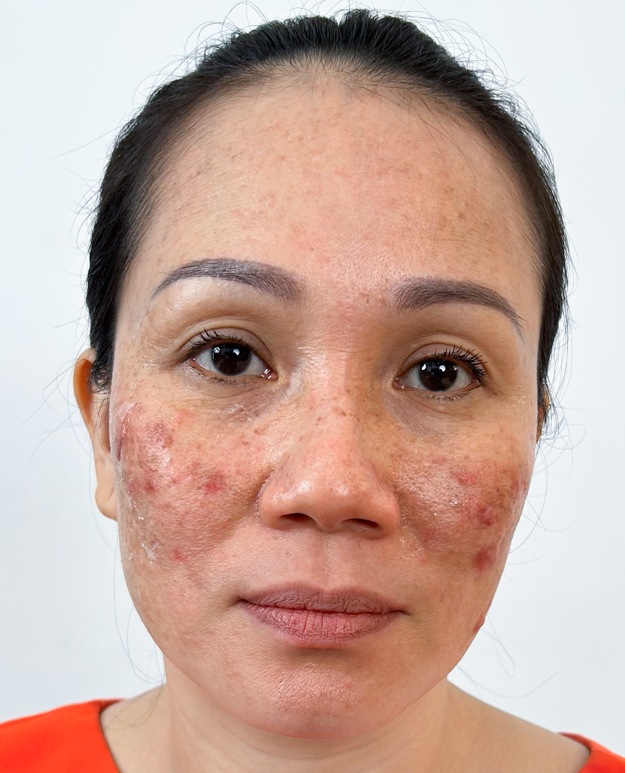 peel da laser tri nam 3 - lavender by chang