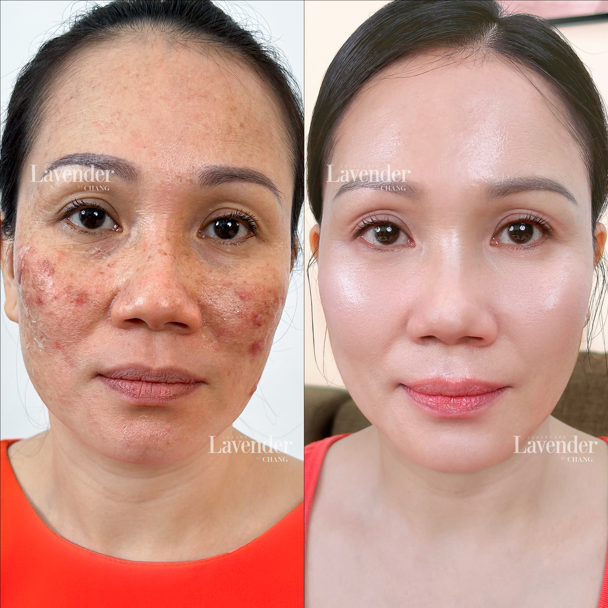 peel da laser tri nam 6 - lavender by chang