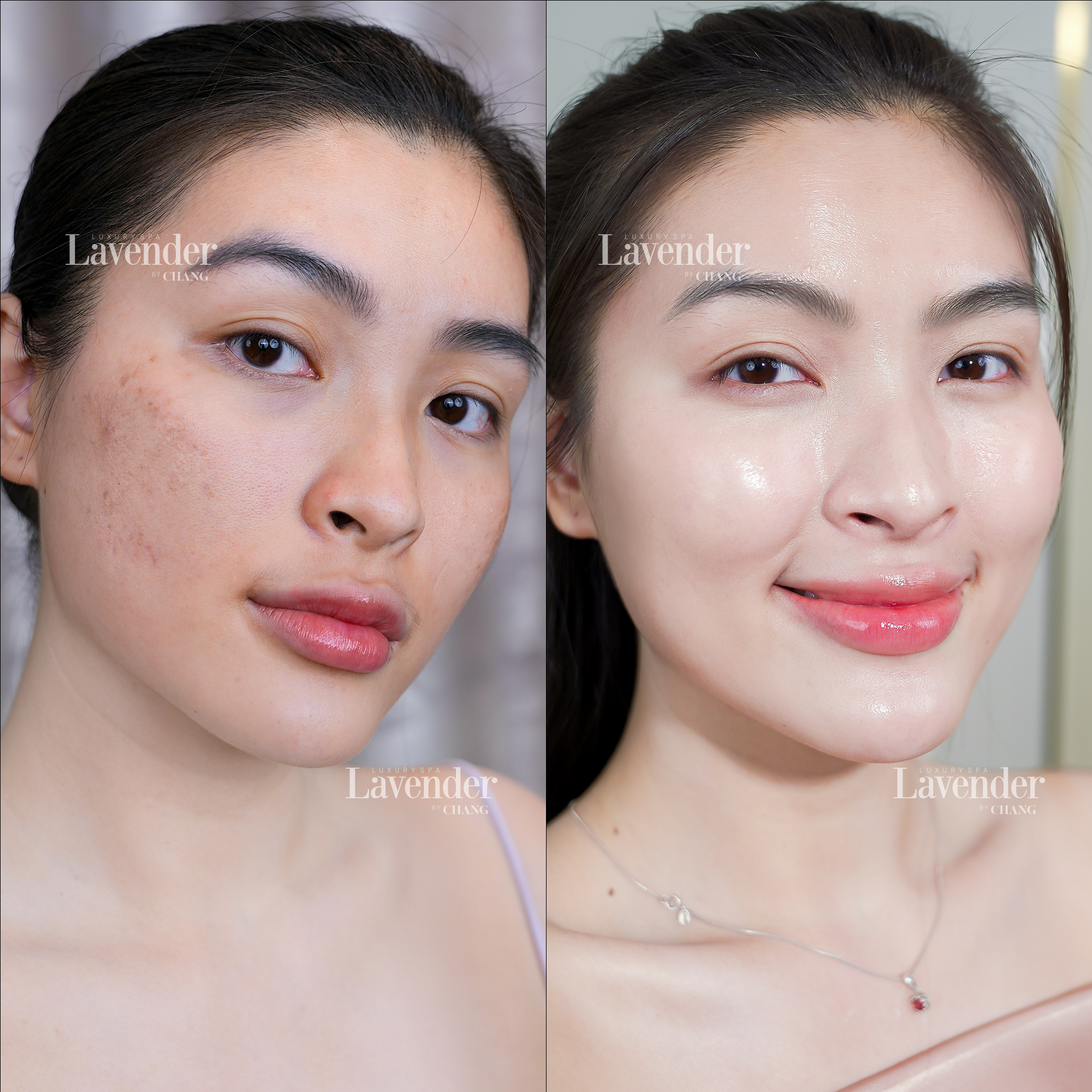 peel da laser tri nam 8 - lavender by chang