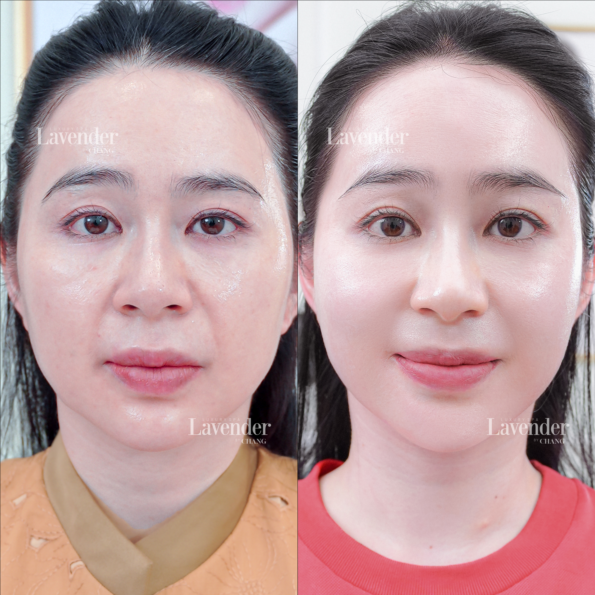 thermage pico pro 4 - lavender by chang