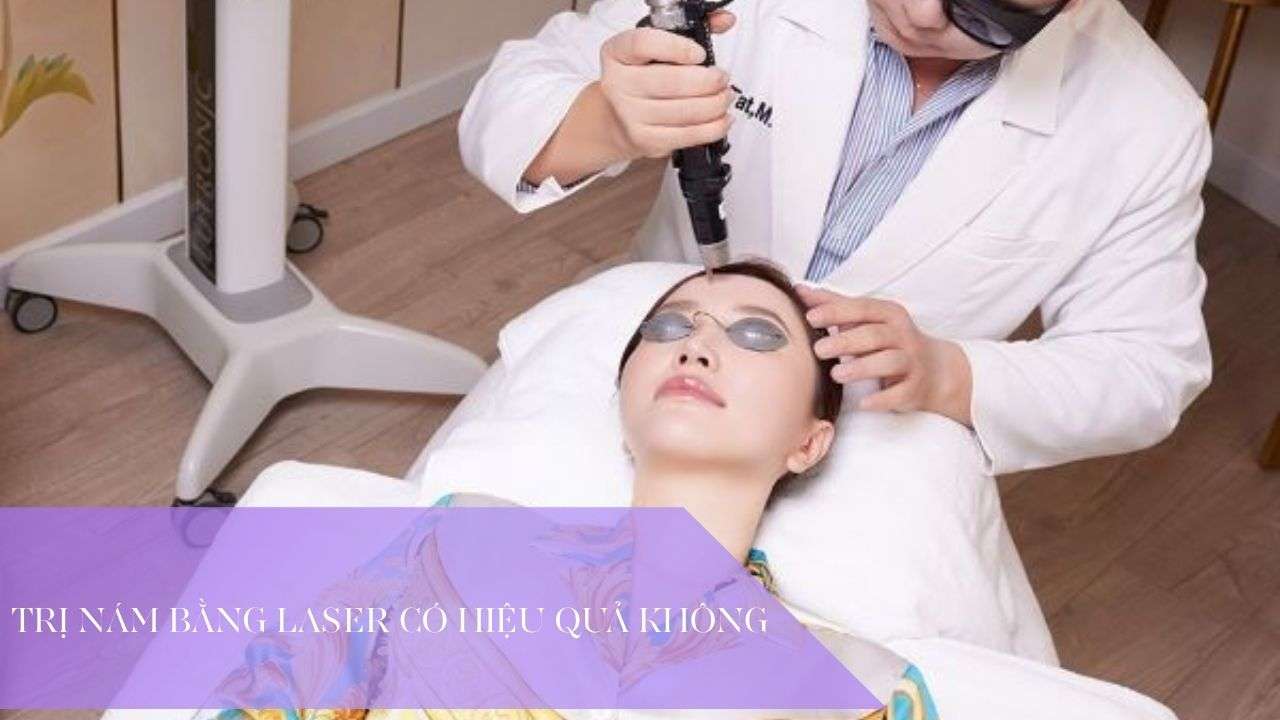 Trị nám bằng laser có hiệu quả không? Có nên điều trị?