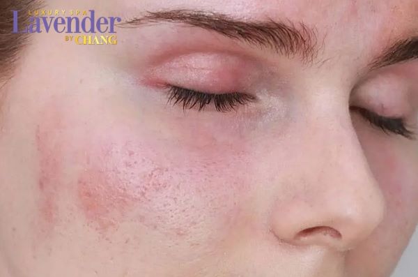 tri nam bang laser co hieu qua khong 5 - lavender by chang