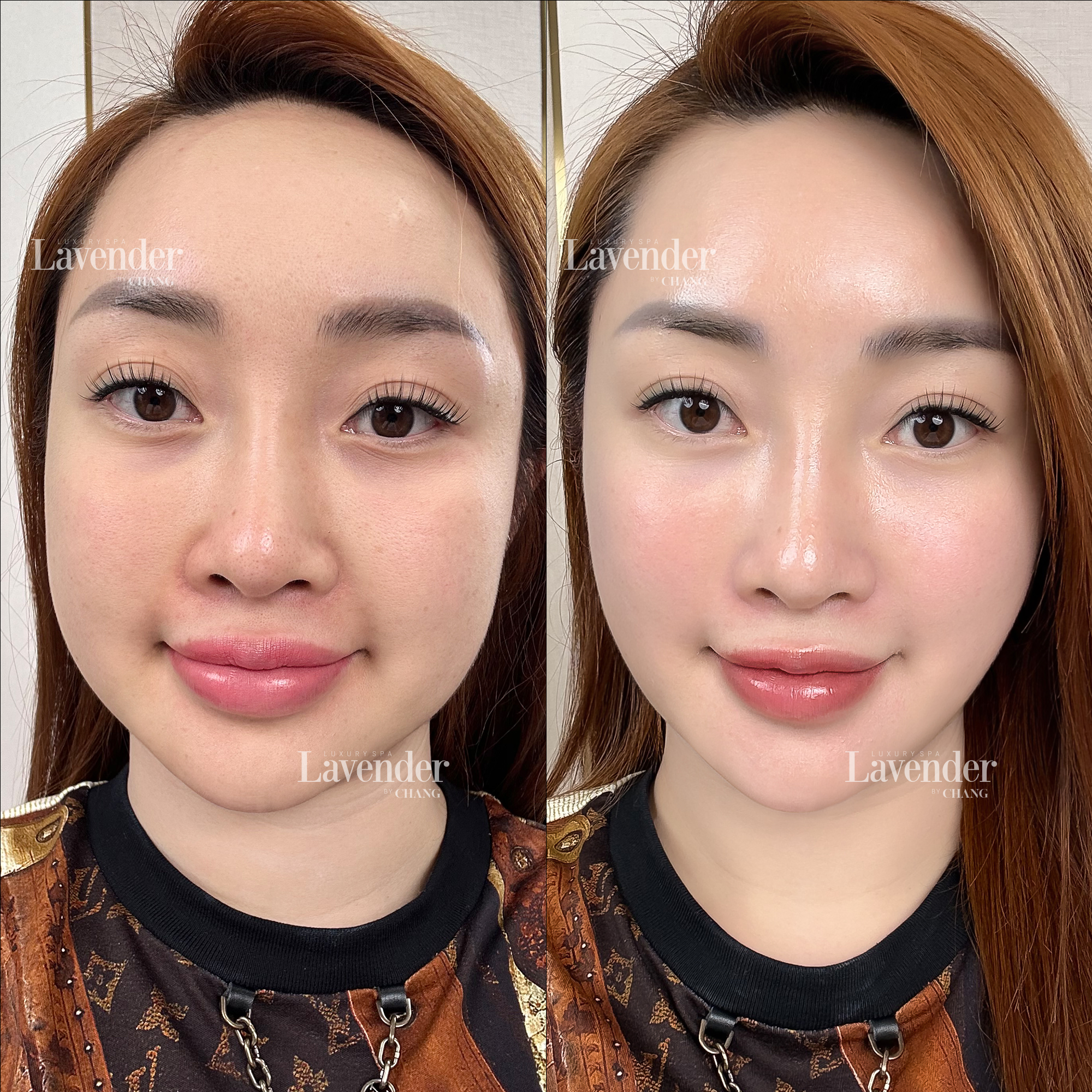 trung quan lam ultherapy prime 4 - lavender by chang