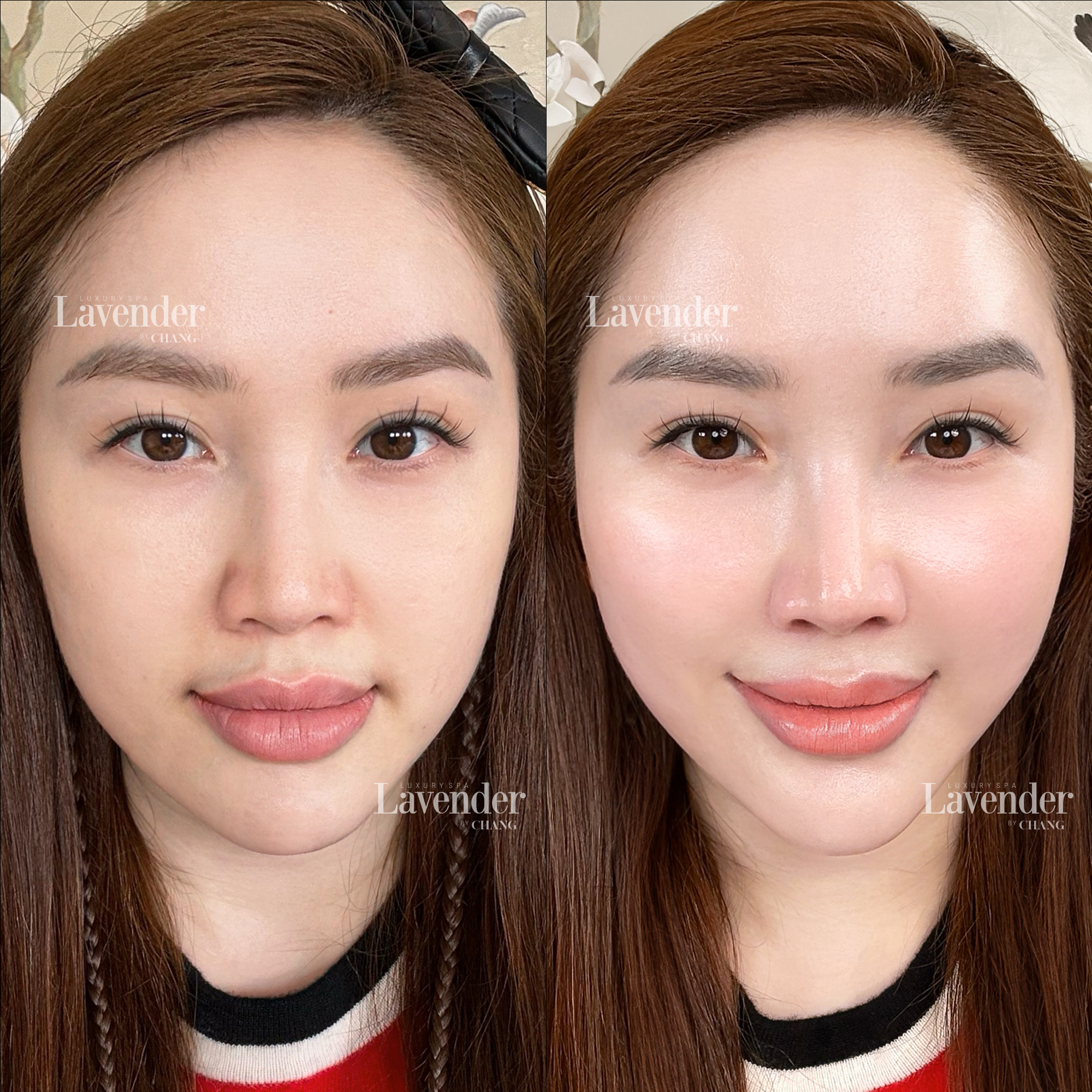 trung quan lam ultherapy prime 7 - lavender by chang