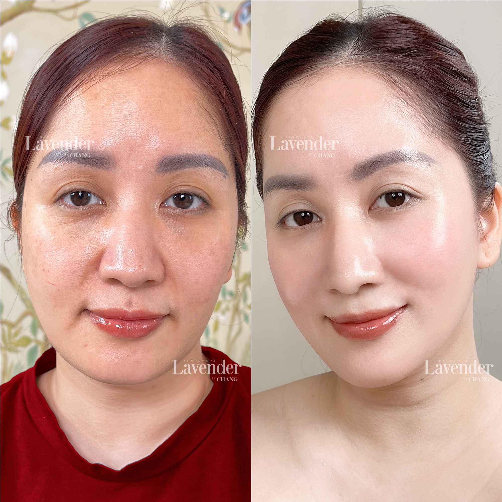 trung quan lam ultherapy prime 8 - lavender by chang