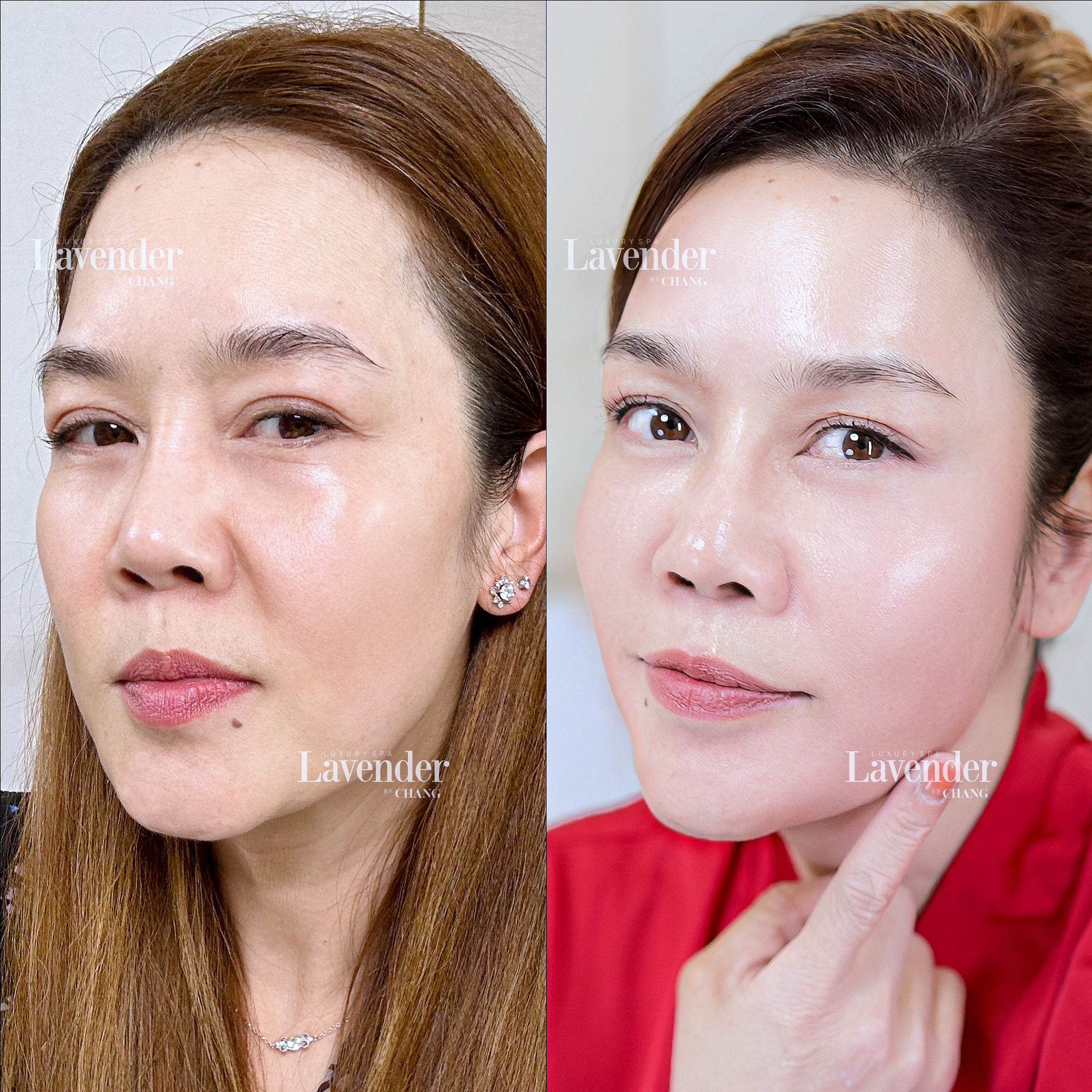 trung quan lam ultherapy prime 9 - lavender by chang