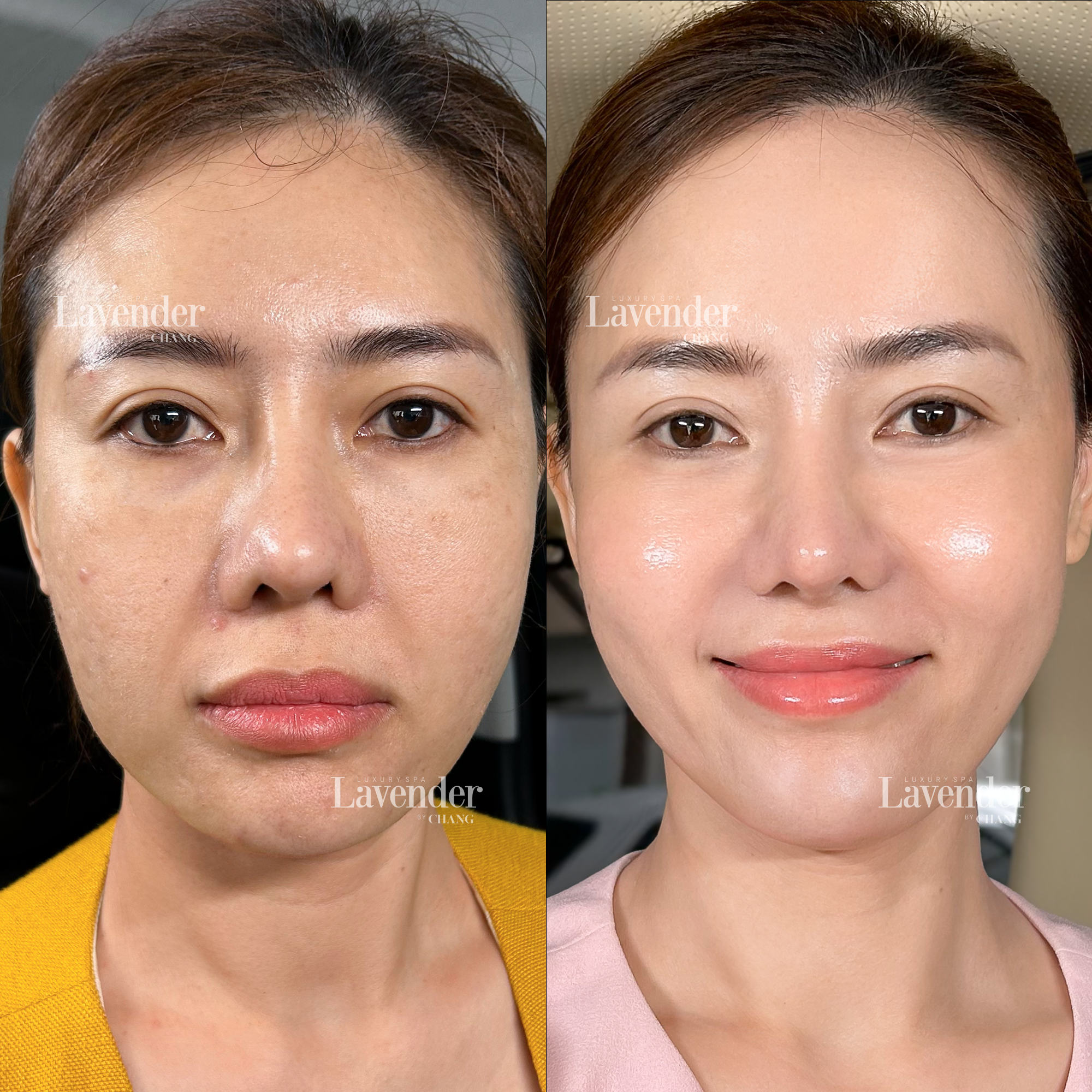 ultherapy prime 4 - lavender by chang