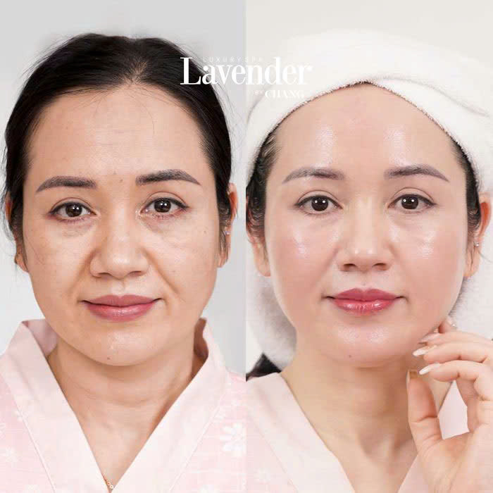 ultherapy prime 5 - lavender by chang