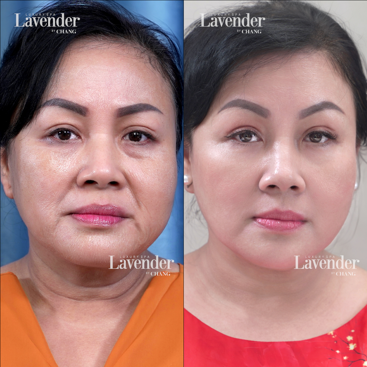 ultherapy prime 6 - lavender by chang