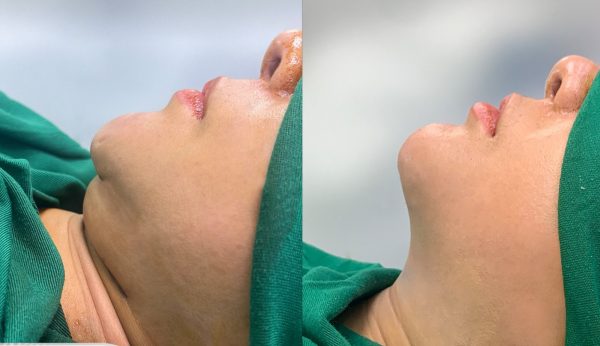 hut mo nong cam co bi lai khong 26105 e1764563025107 - lavender by chang